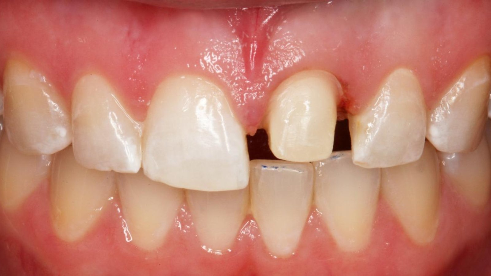 When Should Zirconium Crowns Be Preferred Çağdiş Dental (3)