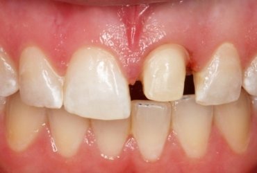 When Should Zirconium Crowns Be Preferred Çağdiş Dental (3)